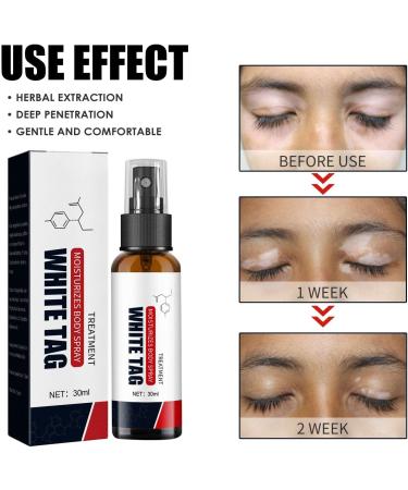 Kolmax Psoriasis Relief Spray - Dermax Treatment for Soothing, Moisturizing Skin - Coal Tar Psoriasis Cream (5 Pcs) - Buy Online on GoSupps.com