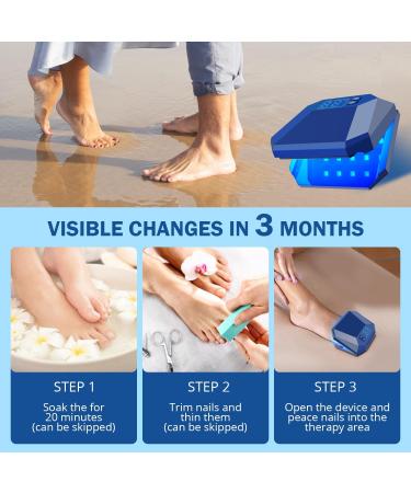 Nail Fungus Cleaning Device for Multiple fingers 905nm Infrared Light + 470nm Blue Light Highly Effective Treatment for Home Use Treat and effectively prevent (Navy) - Buy Online on GoSupps.com