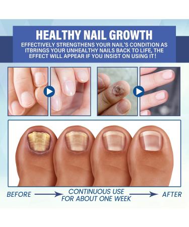 NailPro Nail Fungus LED Light Therapy Device Nail Fungus Laser Nail Fungus Treatment Home Use Nail-Fungus Remover for Toenail Fingernails & Onychomycosis (A01) - Buy Online on GoSupps.com