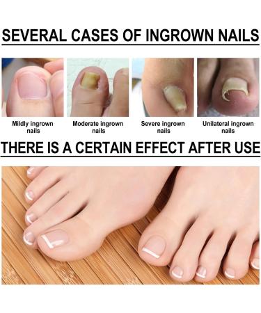 Ingrown Toenail Treatment Fungal Nail Treatment Ingrown Toenail Drops Nail Care and Treatment Strengthen Renew Damaged Nail(30ML) - Buy Online on GoSupps.com
