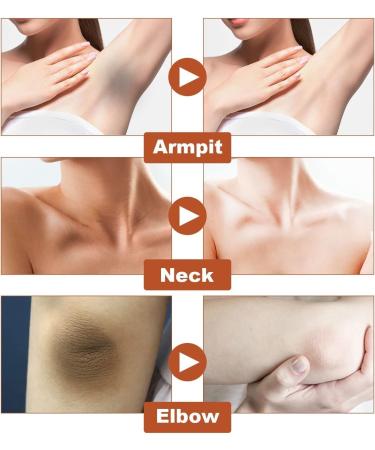 NEUKIN Acantho Clear Therapy Spray - Acanthosis Nigricans Treatment 2Count (Pack of 2) - Buy Online on GoSupps.com