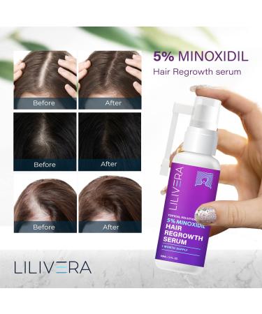 5% Minoxidil Hair Growth Spray for Women and Men - Regrowth Treatment Serum - 60mL - Buy Online on GoSupps.com