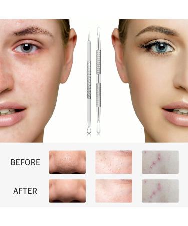 2022 Newest Blackhead Remover Tools - 2 PCS Acne Needles & Whitehead Removal Kit - Professional Stainless Pimple Popper & Extractor Device - Buy Online on GoSupps.com