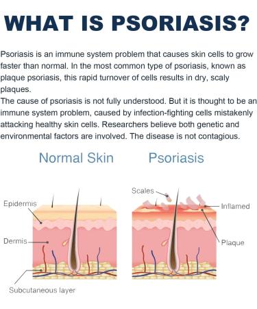 Professional Psoriasis Treatment Cream with New Zealand Bee Venom - Soothing & Moisturizing Formula - 5PCS - Buy Online on GoSupps.com