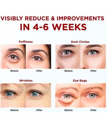 Under Eye Patches 10Pairs Red Ginseng Eye Masks For Puffy Eyes Dark Circles Treatment Under Eye Bags Remover Anti Wrinkle Patches Nourishing Repairing Moisturizing Under Eye Mask Korean Skincare - Buy Online on GoSupps.com