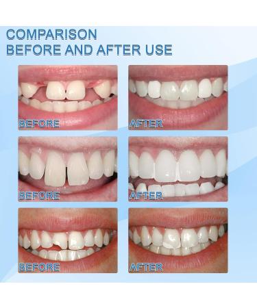 Tooth Repair Granules | Temporary Dental Repair Kit for Broken Teeth | Thermal Fitting Beads | 2PC Tooth Filling Repair Kit - Buy Online on GoSupps.com