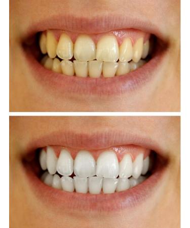 10% Carbamide Peroxide Teeth Whitening Gel - 10 pc Tooth Bleaching Dispensers - Buy Online on GoSupps.com