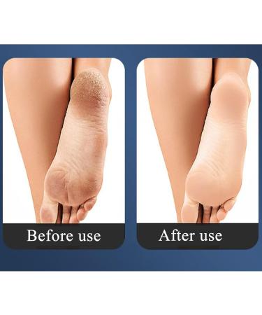 SQAQS Stainless Steel Full Body Foot File Soft Silicone Handle Double Side Pedicure Premium Foot File Dead Hard Cracked Skin Calluses Remover Portable Foot Care Tool - Buy Online on GoSupps.com