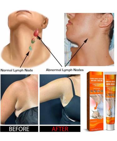 Pommade de Soin Lymphatique Cr me de Gonflement Lymphatique Cr me Douce de Drainage Lymphatique Pour un Soin Efficace de la Lymphe Et un Soulagement De L'enflure - Pommade De Soin des Ganglions Lympha - Buy Online on GoSupps.com