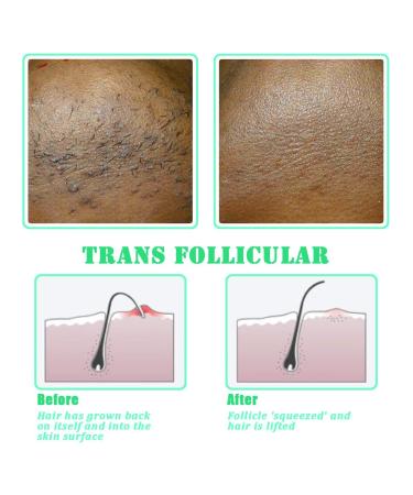 TailaiMei Exfoliating Brush for Ingrown Hair Treatment - Prevent Bikini Bumps & Razor Bumps - Silky Smooth Skin Solution - Men and Women (Green) - Buy Online on GoSupps.com