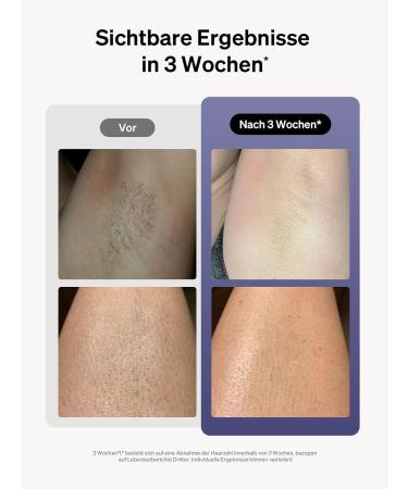 Ulike Air 3 IPL Hair Removal Device - Pain-Free Sapphire Ice Cooling for Home Use | Long-Lasting Laser Hair Removal for Women & Men - Purple - Buy Online on GoSupps.com