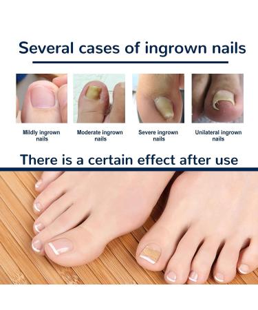100PCS Ingrown Toe Nail Correction Sticker - Health Toenail Corrector Patch - Buy Online on GoSupps.com