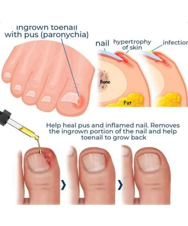 Ingrown Toenail Treatment Oil for Thick, Damaged Nails - Toenailplus Anti Paronychia Relief - Buy Online on GoSupps.com