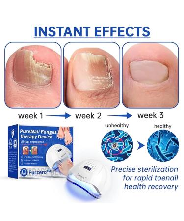 Furzero Purenail Laser Therapy Device - Effective Nail Fungus Treatment Light Therapy Solution for Healthy Nails - Buy Online on GoSupps.com