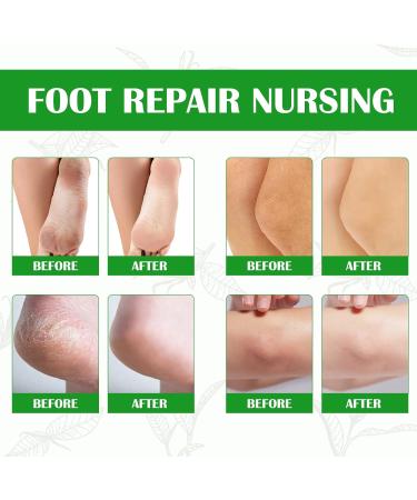 Tongyend Foot Peel Spray Foot Mask Orange Oil Instant Hydrating Nourish Foot Peeling Spray Exfoliator For Cracked Rough Heels & Calluses on Feet Elbows Toes Fingers (GreenTea) - Buy Online on GoSupps.com