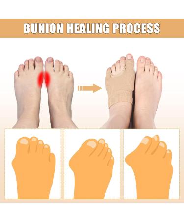 Upgraded Toe Pads - Breathable Bunion Cushion Sleeves for Men & Women | Comfortable Elastic Foot Protectors for Day & Night Relief | 2 Pairs - Buy Online on GoSupps.com