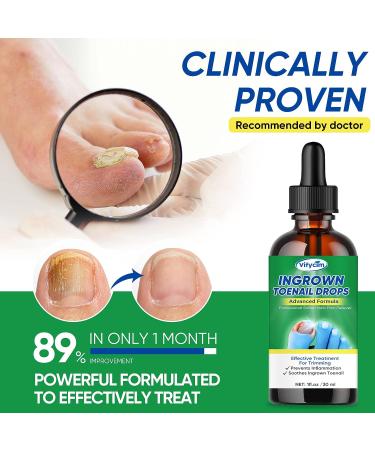 Ingrown Toenail Treatment Drops - Fast Acting Pain Relief & Softener 30ml - Buy Online on GoSupps.com