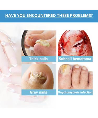 Cracked Toenail Repair Nail Nourishing Solution 30ml Nourishing Fingernail Repair Solution for Bathing Daily Travel Pedicure Manicure Overnight at Home - Buy Online on GoSupps.com