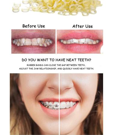Orthodontic Elastic Bands - 500 Pack of Dental Latex Elastics for Tooth Gap Accessories (Fuchs 1/4) - International Shipping Available - Buy Online on GoSupps.com