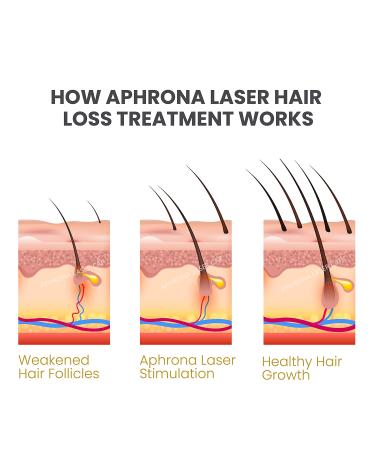 Aphrona Advanced Hair Growth System 272 HairPro - Rechargeable Laser Cap for Hair Regrowth | Clinically Proven, FDA Cleared | Mild to Moderate Hair Loss Solution for Men and Women - Buy Online on GoSupps.com