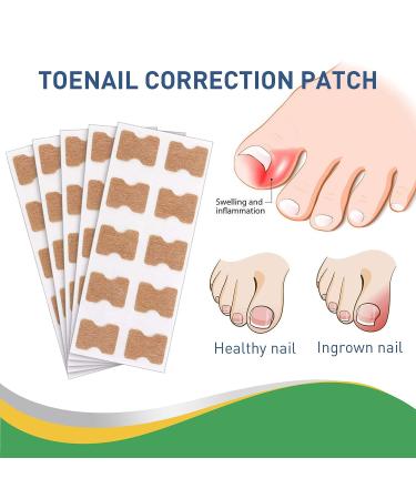Fitmedify Nail Patches - 150 Pcs Ingrown Toenail Correction Stickers for Professional Foot Care - Buy Online on GoSupps.com