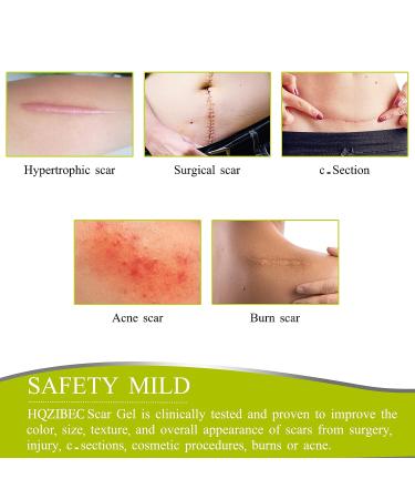 Silicone Scar Tape Roll (3M) - Reusable, Waterproof, 1.6 x 120 inches for Keloids, C-Section, Surgery, Burns, Acne - Scar Removal Treatment - Buy Online on GoSupps.com