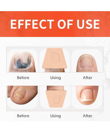 Extra Strength Toenail Fungus Treatment - 32 Pcs Nighttime Renewal Patch for Fast Relief & Visible Results - Buy Online on GoSupps.com