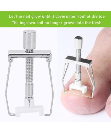 Ingrown Toenail Lifter Tool Ingrown Nail Corrector Professional Ingrown Toe Nail Correction Kit Pedicure Toes Treatment Tools Set for Paronychia - Buy Online on GoSupps.com