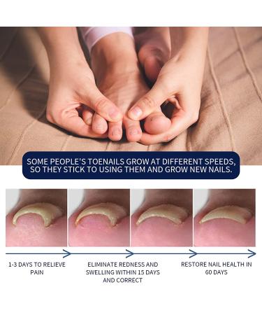 3PCS German Toenailcare Removal Paronychia Oil Treatment & Relief for Healthy Toenails - Buy Online on GoSupps.com