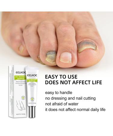 Efero 2PCs Nail Treatment Repair Gel Set - Nail Repair Cream & Essence for Healthy, Beautiful Nails - Toe and Toenail Care Solution - Buy Online on GoSupps.com