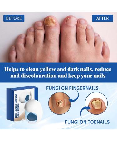 Fivfivgo Light Therapy Device for Nail Fungus Revolutionary Highly Efficient Light Therapy Device for Toenail Diseases Portable Device for Cleaning and Care of Nails - Buy Online on GoSupps.com