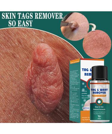 Skin Tag and Mole Removal Lotion - Fast-Acting Natural Remover for Warts - Easy Home Treatment (2PCS 40ML) - Buy Online on GoSupps.com