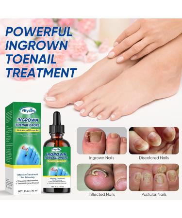 Ingrown Toenail Treatment Drops - Fast Acting Pain Relief & Softener 30ml - Buy Online on GoSupps.com