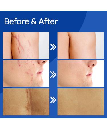 Wewell Medical-Grade Silicone Scar Gel | Advanced Treatment for Old & New Scars on Face & Body - Buy Online on GoSupps.com
