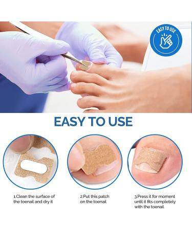 Ingrown Toenail Corrector Patch - 100PCS Treatment Strips | Foot Care Tool for Painless Toenail Correction - Buy Online on GoSupps.com