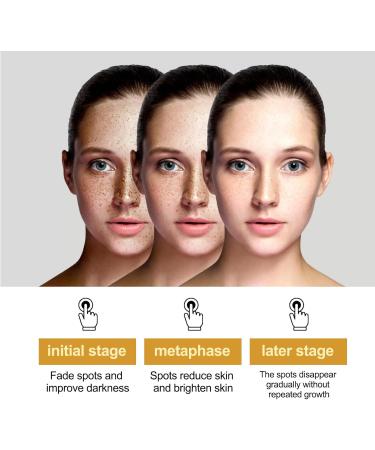 KOAHDE Whitening Freckle Cream Facial Spot Removing Cream Moisturizing Anti-Blemish Cream Spot Lightening Cream for Face Dark Spots Remover Skin Whitening Cream Brightening Whitening Tone up Cream - Buy Online on GoSupps.com