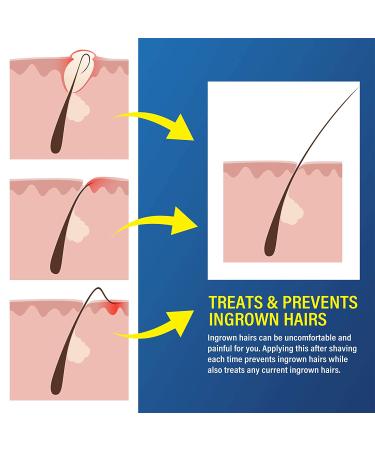 Terez & Honor Razor Bump Serum - After Shave Roll-On for Ingrown Hairs, Burns & Bumps - Men and Women (Pack of 2, 7.06 oz) - Buy Online on GoSupps.com