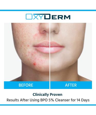 Acne Face Wash Treatment with 5% Benzoyl Peroxide - Clinically Proven Cleanser for Cystic Breakouts Oily Skin Blackheads & Pimples - Buy Online on GoSupps.com