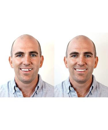 Instant Smile Triple Shade Temporary Tooth Kit - Quick & Easy Solution to Replace Missing Teeth - Buy Online on GoSupps.com