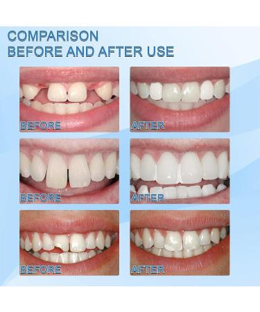 Temporary Adhesive Kit for Missing Denture Teeth Repair - Smile Confidently with False Teeth Straightener (30g, White) - Buy Online on GoSupps.com