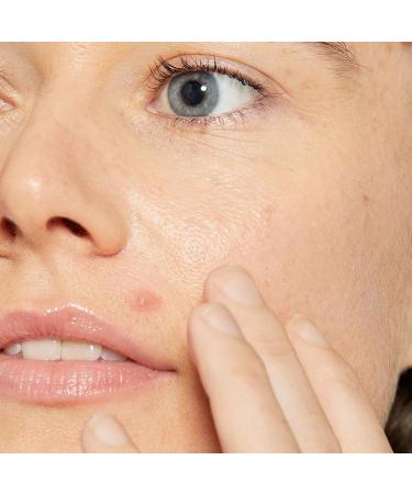 Dermalogica Deep Acne Liquid Patch | Invisible Spot Treatment for Pimples & Blemishes | Sulfur-Based Skin Soothing Solution - 0.5 fl oz - Buy Online on GoSupps.com