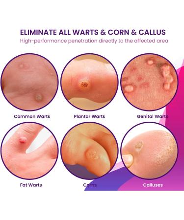 KRONA Fast Acting Liquid Gel Maximum Strength for Plantar Wart Genital Wart Corn Common Wart Calluses - 0.5 Fl Oz - Buy Online on GoSupps.com