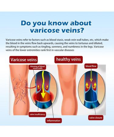 B ton de r paration des jambes pour varices b ton de peau pour jambes cr me pour liminer les veines d'araign e pour une meilleure circulation et un soulagement des jambes lourdes fatigu es | Non 1 - Buy Online on GoSupps.com