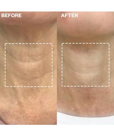 Wrinkles Schminkles Neck & Chest Patch Set - Hyaluronic Silicone Smoothing Pads for Wrinkles Stretch Marks and Cleavage Care | Reusable & Hypoallergenic - Buy Online on GoSupps.com