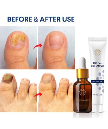Toenail Fungus Treatment Kit - Nail Repair Cream and Liquid (15ML/20G) | Extra Strength Fungus Nail Treatment - Buy Online on GoSupps.com
