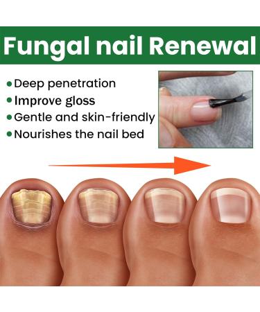 Extra Strong Fungal Nail Serum for Toe and Finger - Repair, Renew, Strengthen Nails - Buy Online on GoSupps.com