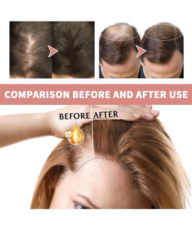 Hair Growth Serum Deep Nourishing Oil Ampoules Set for Thinning Hair Natural Hair Loss Treatment for Women Men Thinning Hair Repair Scalp Hydration Strengthening Repair for Damaged Hair (1PCS) - Buy Online on GoSupps.com