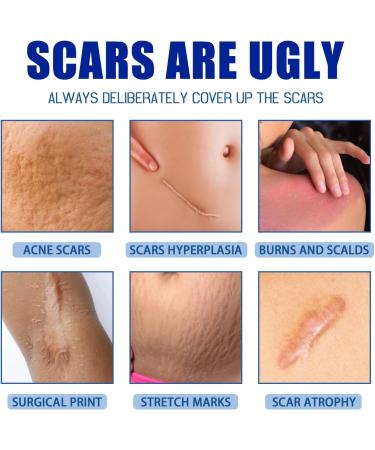 Skin Scar Repair Solution for All Skin Types - Gentle Scar Removal Treatment - Buy Online on GoSupps.com