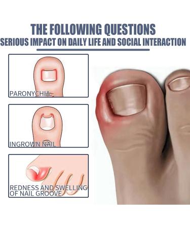 Ingrown Toenail Treatment Oil - Anti Paronychia Relief & Nail Growth Formula - Buy Online on GoSupps.com