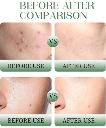 Dark Spot Correcting Glow Serum - Salicylic Acid Serum - Face Serum for Women - Acne Removal & Oil Control - Salicylic Acid Serum for Blackhead Remover - Anti Aging Serum Skincare All Skin Types - Buy Online on GoSupps.com